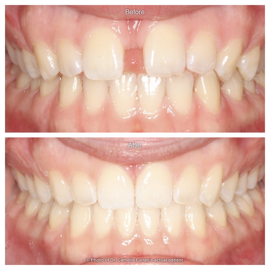 Cosmetic dentist gap in teeth