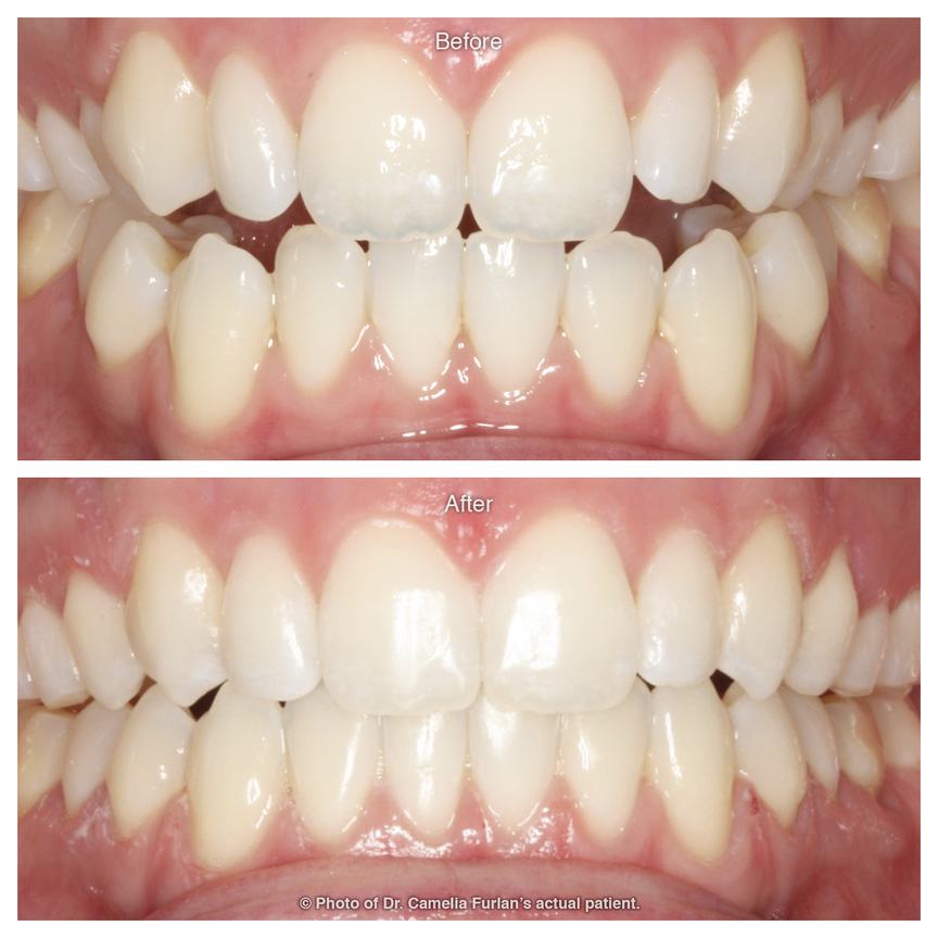Cosmetic smile makeover for nice looking teeth
