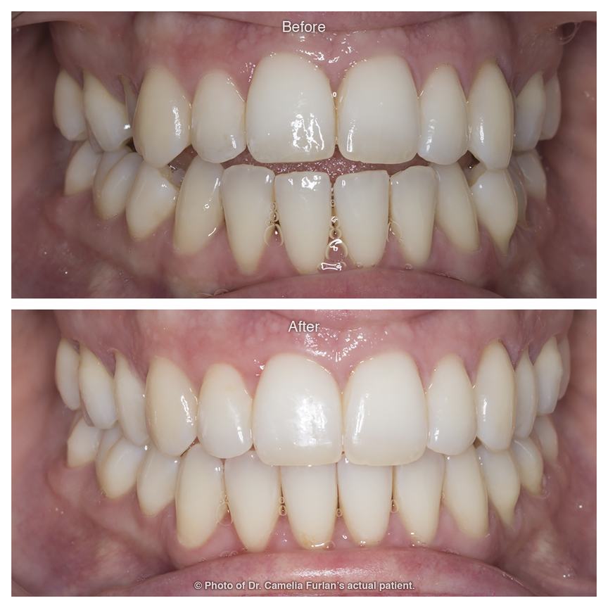 Fixing bite alignment with orthodontic treatment