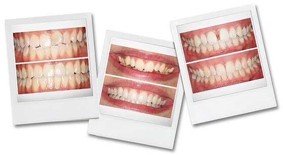 click here to visit the before and after smile gallery