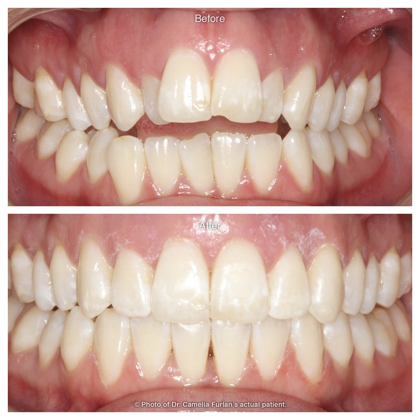 Wonky misaligned and crowded teeth